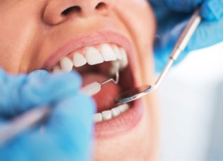 Le détartrage dentaire - techniques - avantages